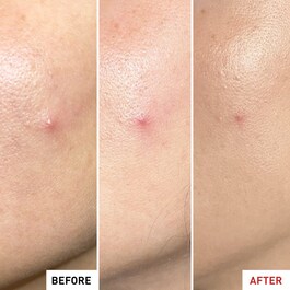 Centella SOS Patch - Gel Efecto Parche
