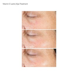 Vitamina C Láctico - Cuidado del Contorno de Ojos Radiante