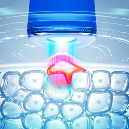 ESPADA ™ - Dispositivo de luz pulsada azul contra el acné