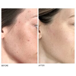 Alpha Beta® - Peeling Diario Fórmula Universal