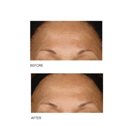 Alpha Beta® - Peeling Diario Fórmula Intensa