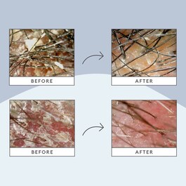 Soluciones para el cuero cabelludo graso - Set para el cabello
