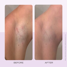 Ingrown Hair Pads - Discos compostables para vello encarnado x60