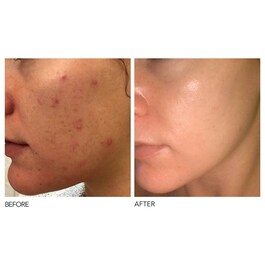 Alpha Beta® - Peeling Diario Fórmula Intensa