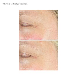 Vitamina C Láctico - Cuidado del Contorno de Ojos Radiante