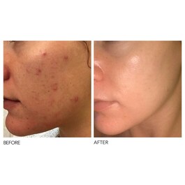 Alpha Beta® - Peeling Diario Fórmula Intensa