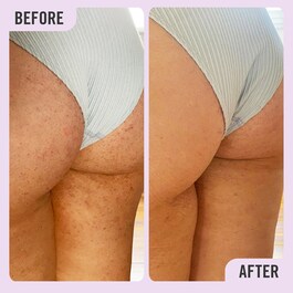 KP Bump Eraser Body Scrub with 10% AHA - Exfoliante corporal con AHA