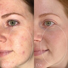 Vinopure Sérum Salicílico Anti-imperfecciones -Sérum