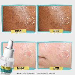 Truly targeted blemish - clearing solution
