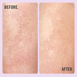 KP Bump Eraser Body Scrub with 10% AHA - Exfoliante corporal con AHA