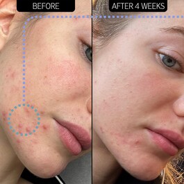 Hidratante anti-imperfecciones - 2% NovoRetin™